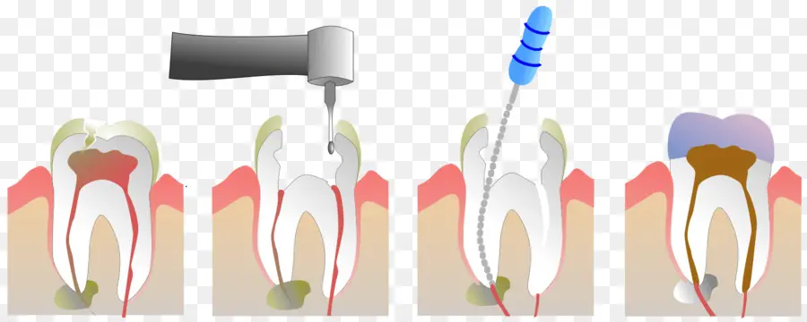Endodontik Terapi，Bubur PNG