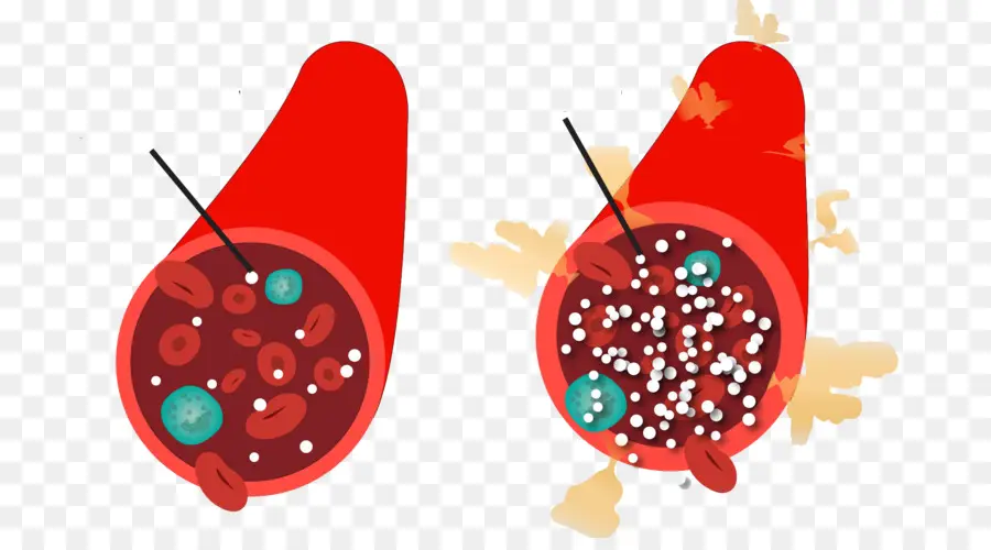 Gula Darah，Hiperglikemia PNG