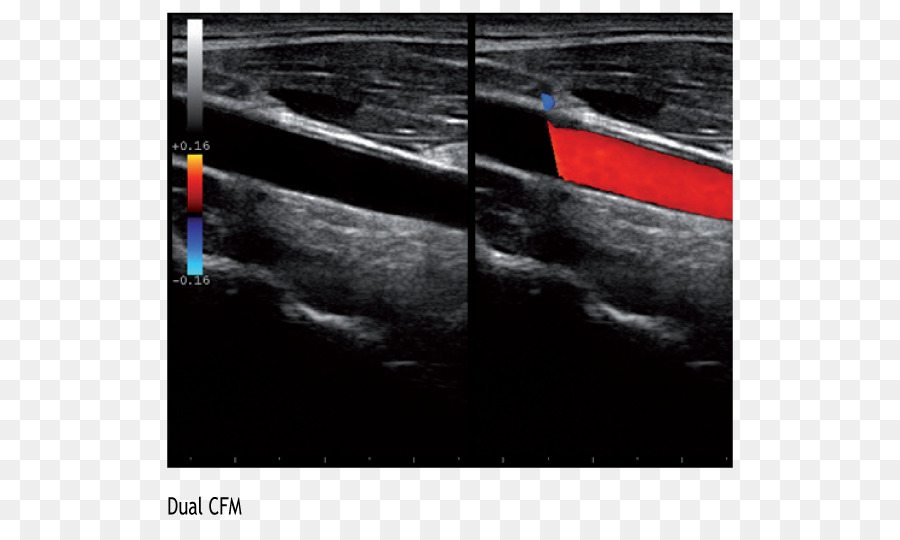 Ultrasonografi，Arteri Karotid Umum PNG