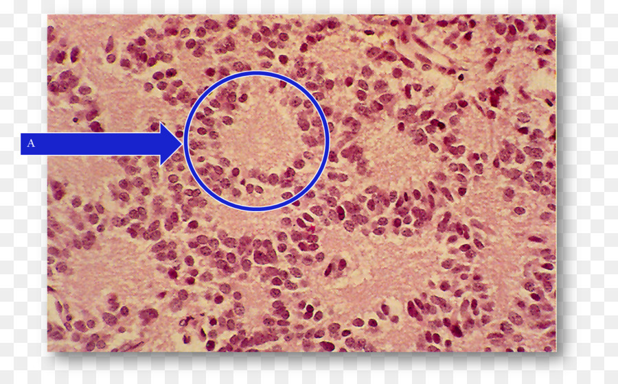 Pineocytoma，Pinealoblastoma PNG