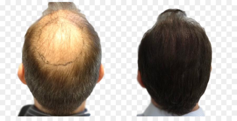 Transplantasi Rambut，Unit Folikular Ekstraksi PNG