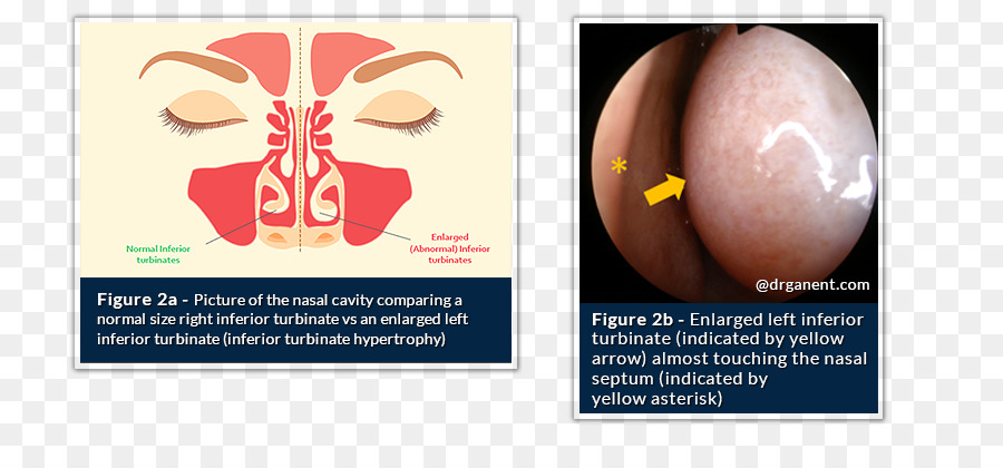 Hidung Concha，Otorhinolaryngology PNG