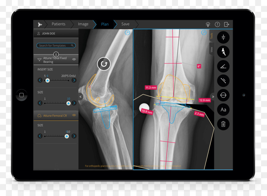 Sinar X Pada Tablet，Diagnosa PNG