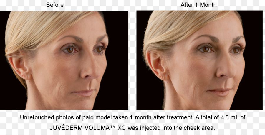 Suntik Filler，Juvederm PNG