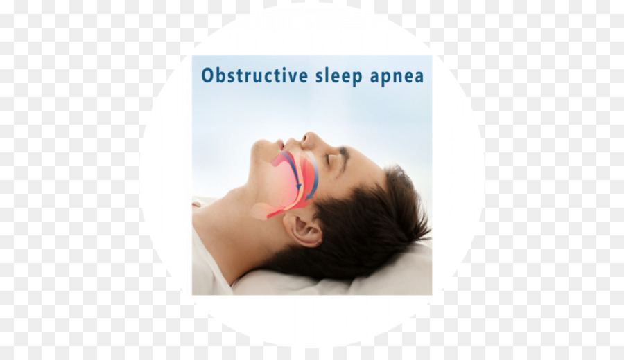 Obstructive Sleep Apnea Pada Orang Dewasa，Apnea Tidur PNG