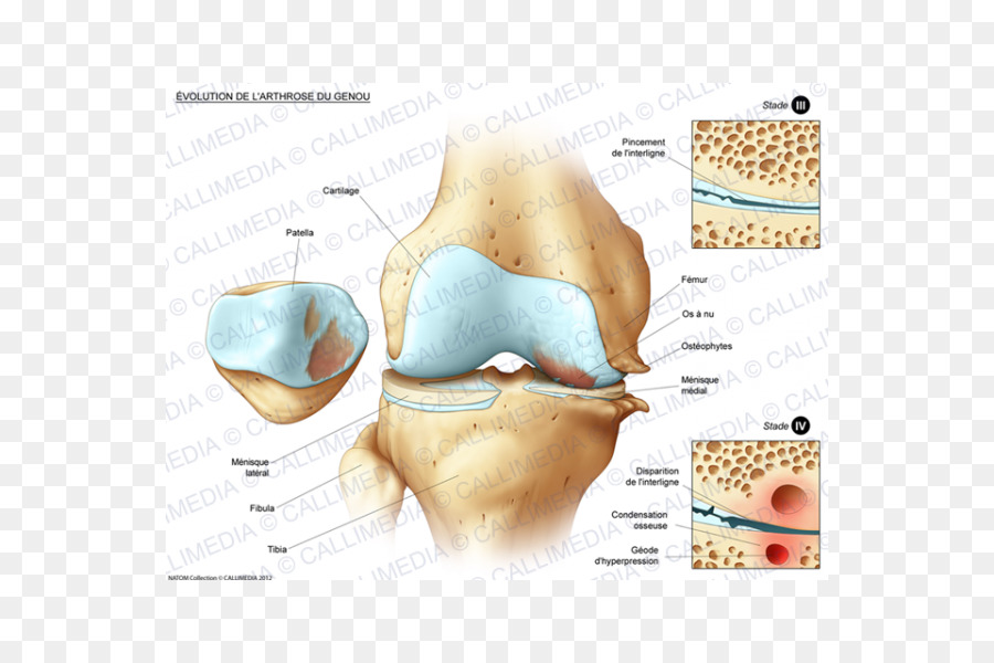 Patah Tulang，Lutut PNG