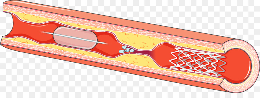 Stent，Pembuluh Darah PNG