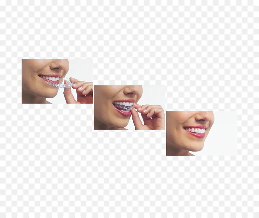 Clear Aligner，Kawat Gigi PNG