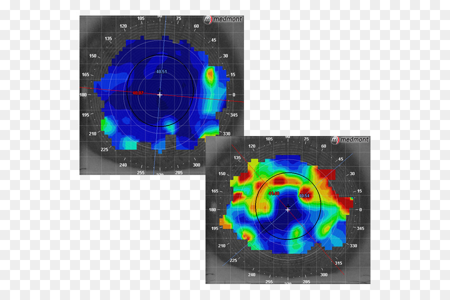 Sindrom Mata Kering，Topografi Kornea PNG