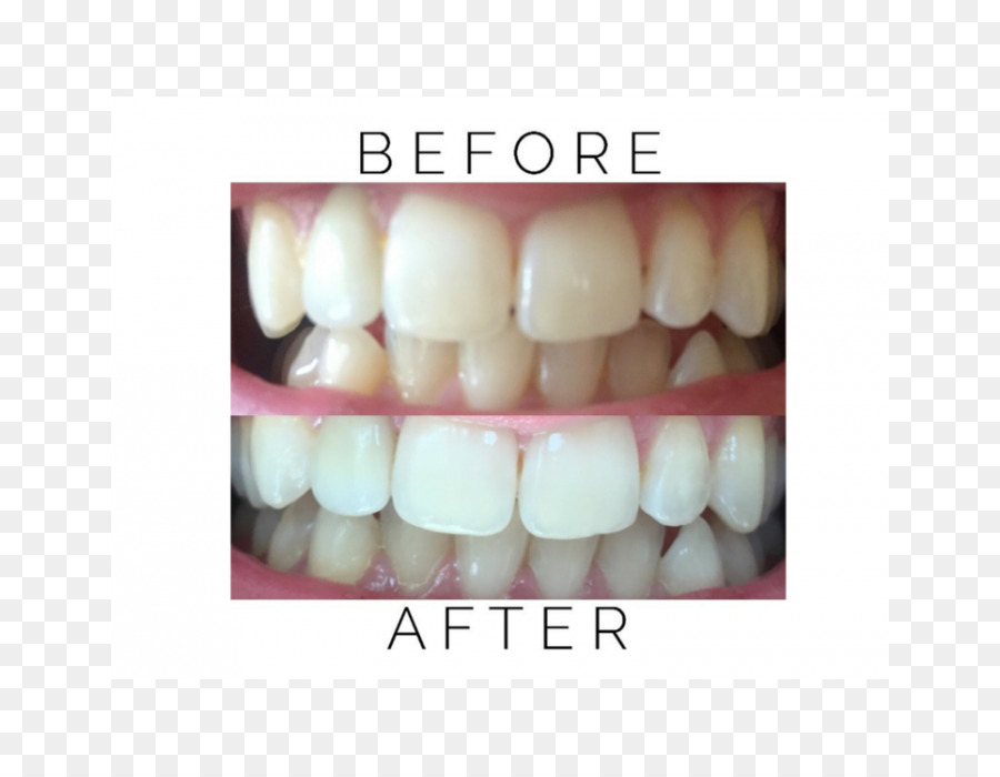 Pemutihan Gigi，Dental PNG