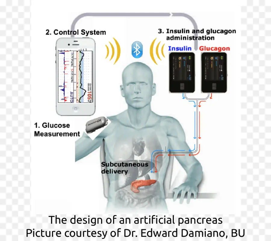 Pankreas Buatan，Diabetes PNG