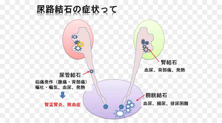 Batu Ginjal，Kalkulus PNG