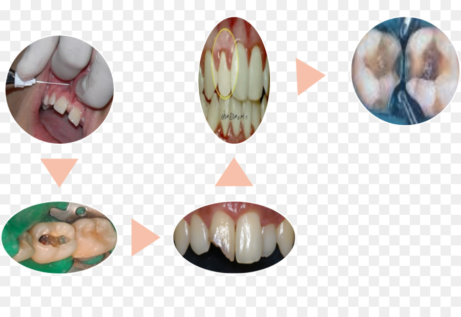 Endodontik Terapi，Root Canal PNG