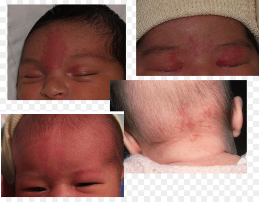 Nevus Flammeus Nuchae Bayi Tanda Lahir Gambar Png