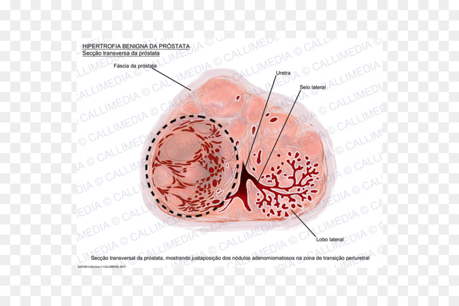 Prostat，Kelenjar PNG