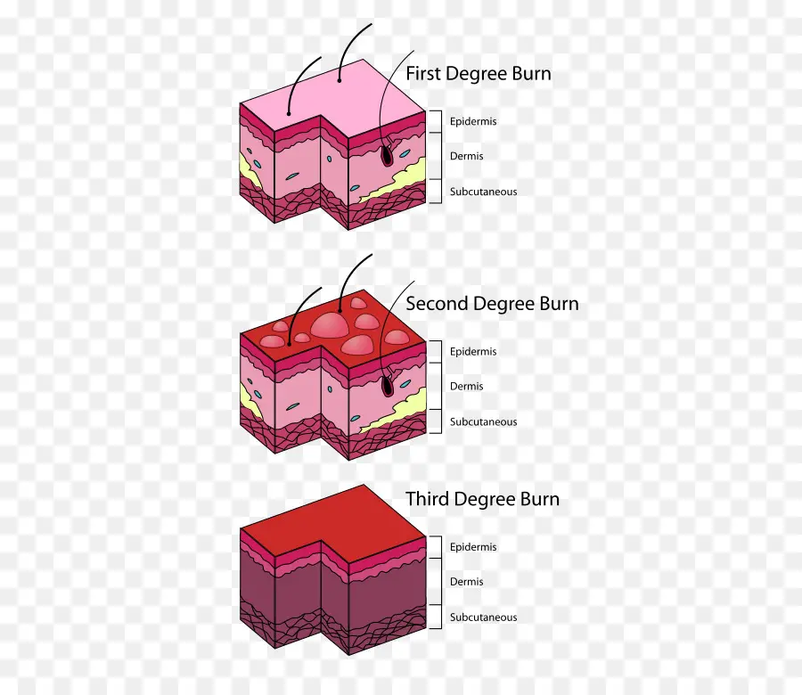 Derajat Luka Bakar，Membakar PNG